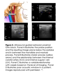 Glossopharyngeal Neuralgia: An Approach to Diagnosis and Management ...