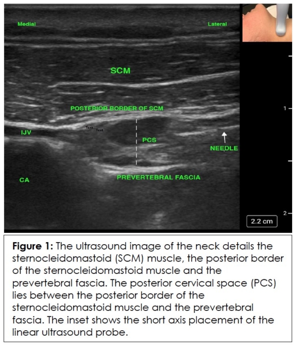 Intermediate Cervical Plexus Block Icpb In Refractory Chronic Daily Headache After Whiplash 1067