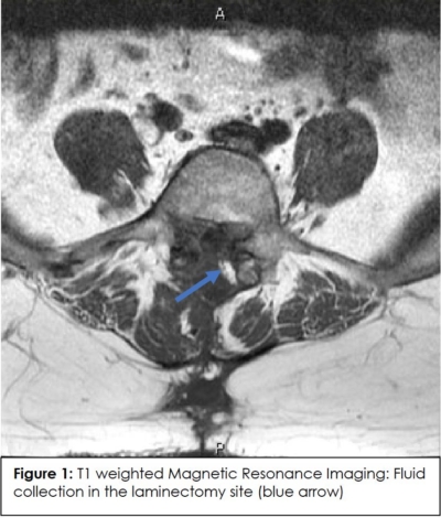 Post-Surgical CSF leak with Inconclusive Diagnostic Studies: A Case ...